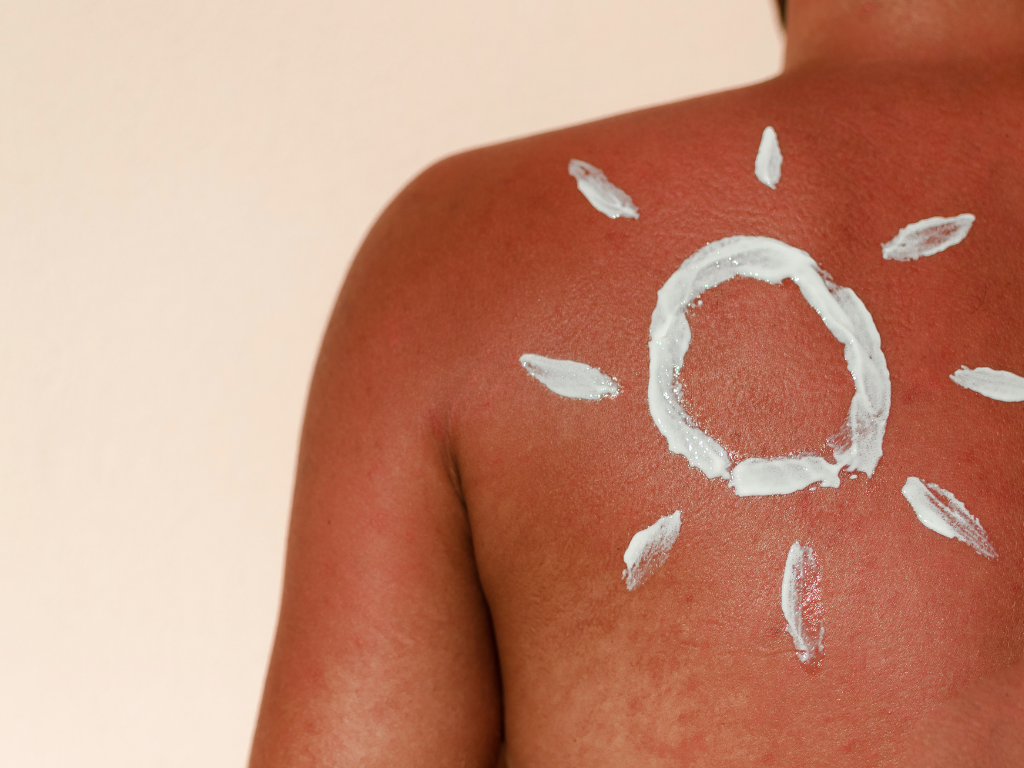 How to treat minor burns