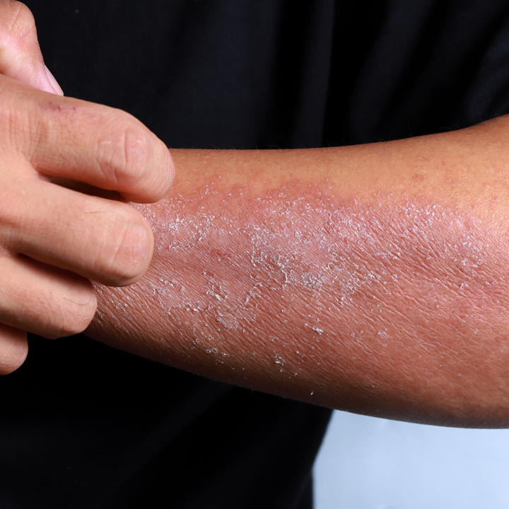 Dry, Cracked Skin can Spread Germs.
